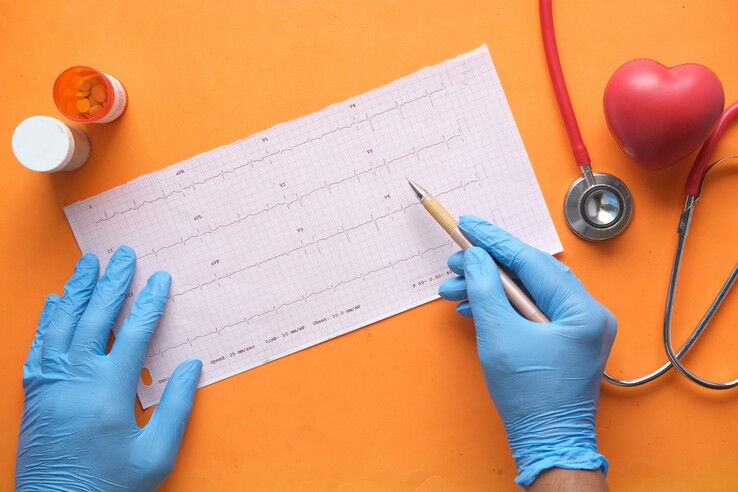 Symbolbild, so sieht ein EKG mit mehreren Ableitungen aus - Auswertung mit Stift und Papier ist nach wie vor nicht komplett ungewöhnlich