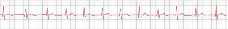 Sogar günstige Smartwatches können nachweislich taugliche EKGs zumindest anfertigen