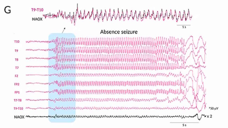 Hier (schwarzer Graph!) soll das System eine Absence und damit einen epileptischen Anfall aufgezeichnet haben, zu sehen sind die postiktalen Veränderungen in der Hirnaktivität. Zumindest optisch abgeschätzt besitzt das medizinische Mehrkanal-EEG ein besseres Signal-Rausch-Verhältnis (Bildquelle: Naox)