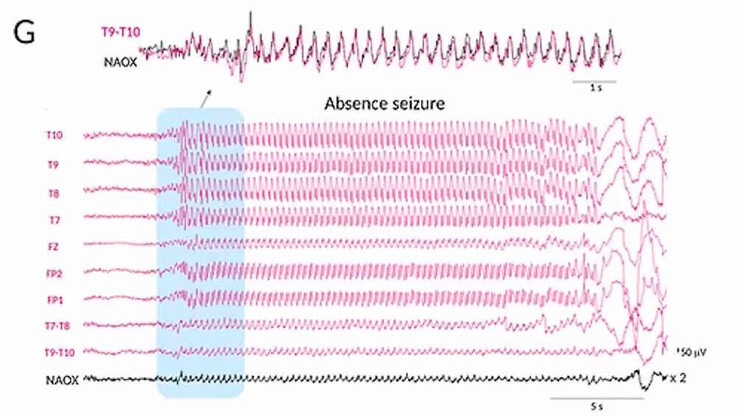 Hier (schwarzer Graph!) soll das System eine Absence und damit einen epileptischen Anfall aufgezeichnet haben, zu sehen sind die postiktalen Veränderungen in der Hirnaktivität. Zumindest optisch abgeschätzt besitzt das medizinische Mehrkanal-EEG ein besseres Signal-Rausch-Verhältnis (Bildquelle: Naox)
