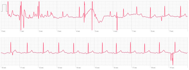 Die Ableitung II nach Einthoven, hier wird die Huawei Watch D2 schon stark außerhalb ihrer Spezifikationen genutzt - das EKG bleibt aber durchaus nutzbar