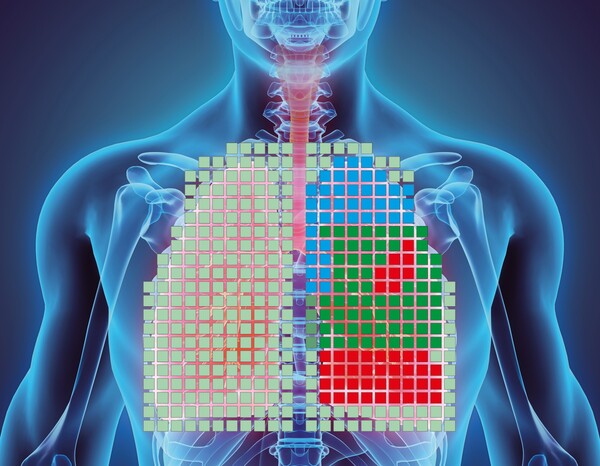 Bild: Fraunhofer IKTS - Die visuelle Darstellung zeigt die unterschiedlichen Bereiche der Lunge und ihre Belüftungssituation. Rot steht für schlechter belüftete Bereiche.