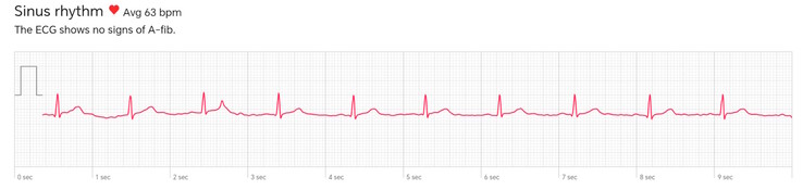 Ausschnitt eines von der Watch D3 angefertigten EKGs: So sollte es aussehen, der Proband hat keine Rhythmusstörungen