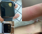 Apple Watch SE überhitzt, Nutzer melden sich mit Verbrennungen am Handgelenk (Bilder: Reddit).