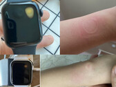 Apple Watch SE überhitzt, Nutzer melden sich mit Verbrennungen am Handgelenk (Bilder: Reddit).