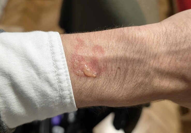 Angeblich von der Galaxy Watch 5 Pro verursachte Brandmale.
