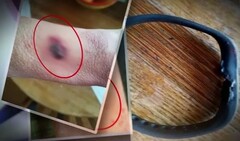 Fitness-Tracker: Fitbit Flex 2 am Armgelenk explodiert