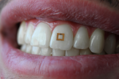 Wearable: Sensor auf Zahn analysiert Ernährung Bild: SilkLab, Tufts University